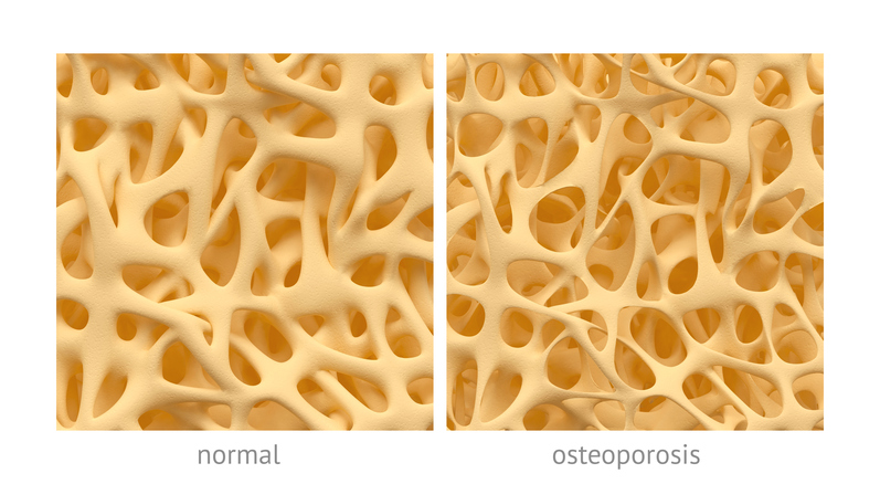 bot met normale structuur en met structuur bij osteoporose